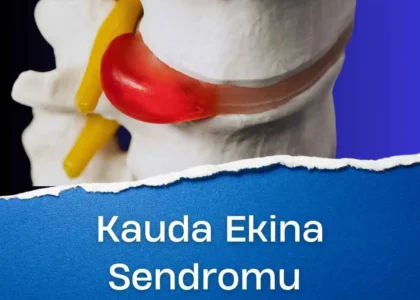 kauda ekina sendromu