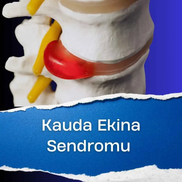 Kauda Ekina Sendromu | Bel Fıtığı Komplikasyonu