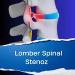 Lomber Spinal Stenoz