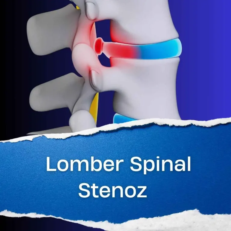 Lomber Spinal Stenoz Nedir? | Belde Kanal Daralması