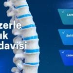 lazerle fıtık tedavisi